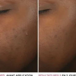 It CosmeticsBye Bye Breakout                Sérum anti-acné à l'acide salicylique