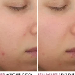 It CosmeticsBye Bye Breakout                Sérum anti-acné à l'acide salicylique